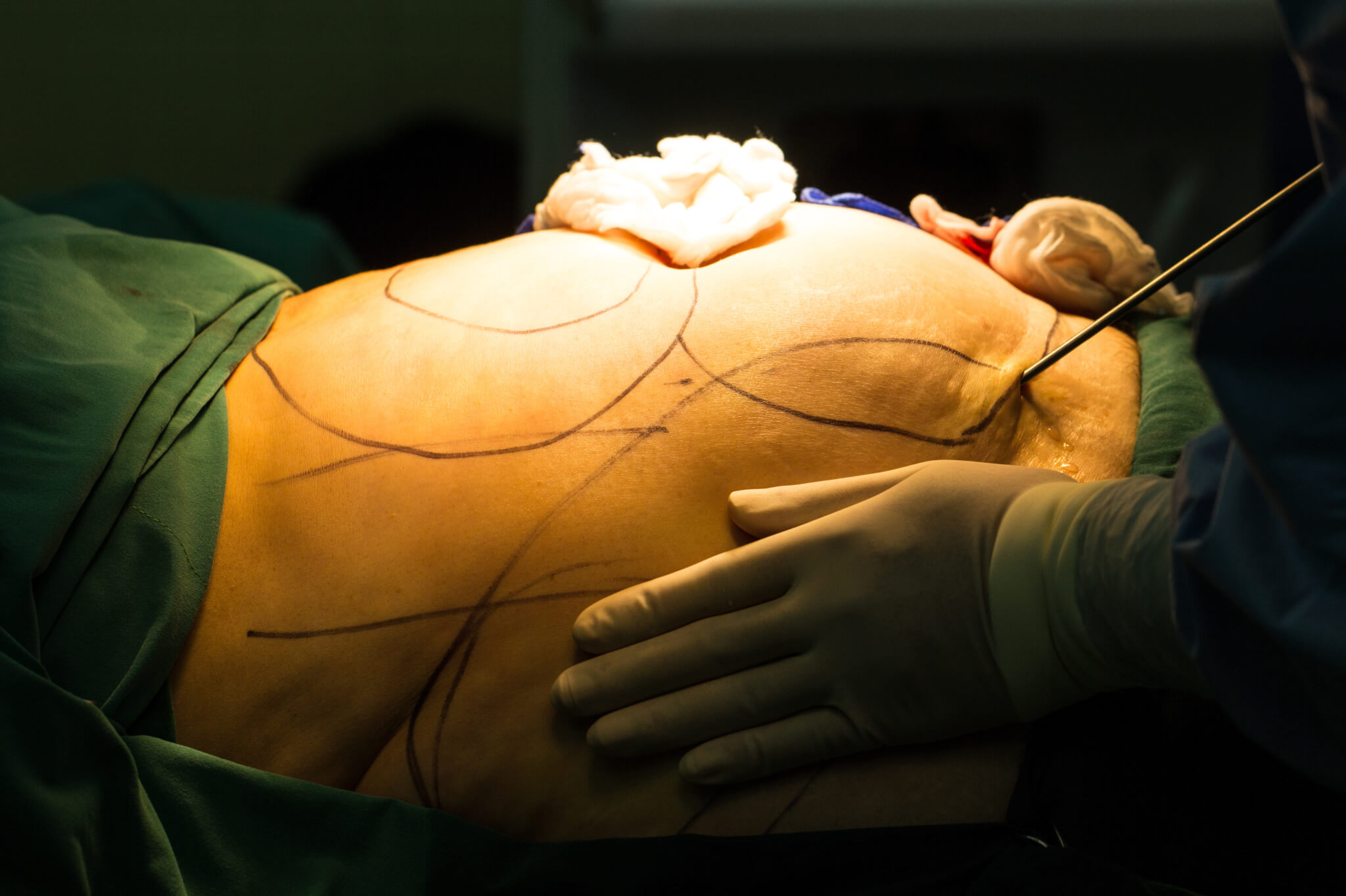 Is Laser Used When Getting an AirSculpt? Fat Procedures